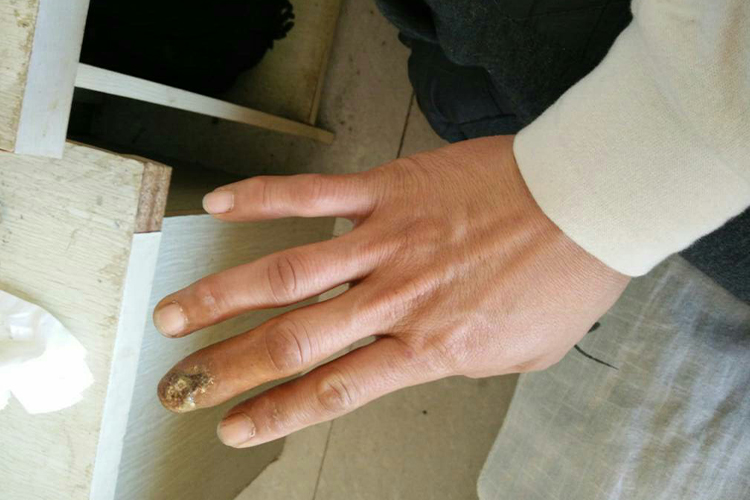 单只手指肿图 单只手指肿图