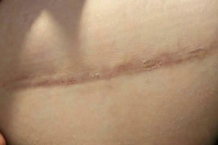 剖宫产3个月后刀口图