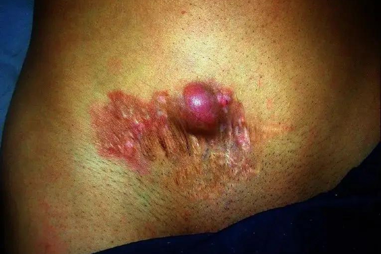 皮肤纤维瘤图 皮肤纤维瘤图