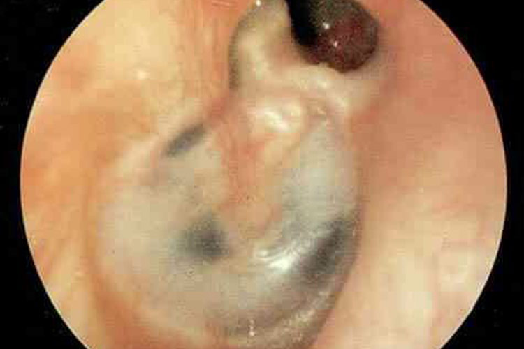 外耳道腺样囊性癌图 外耳道腺样囊性癌图