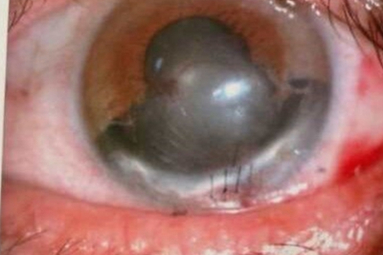典型性虹膜缺损眼球缺损图