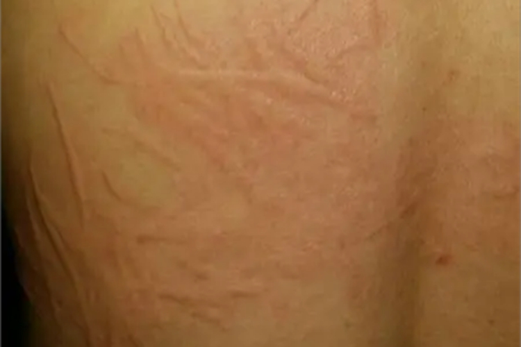 人工荨麻疹条纹图 人工荨麻疹条纹图
