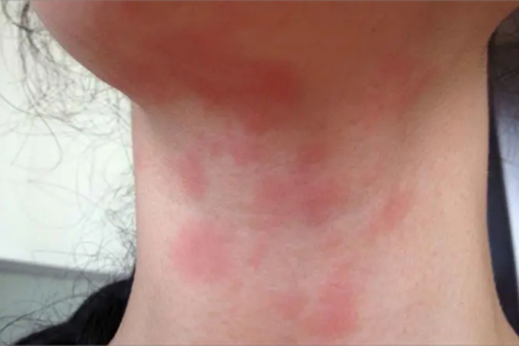 热接触性荨麻疹前颈大红疙瘩图 热接触性荨麻疹前颈大红疙瘩图