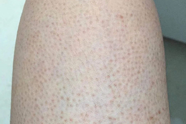 毛发苔藓大腿长红点图 毛发苔藓大腿长红点图