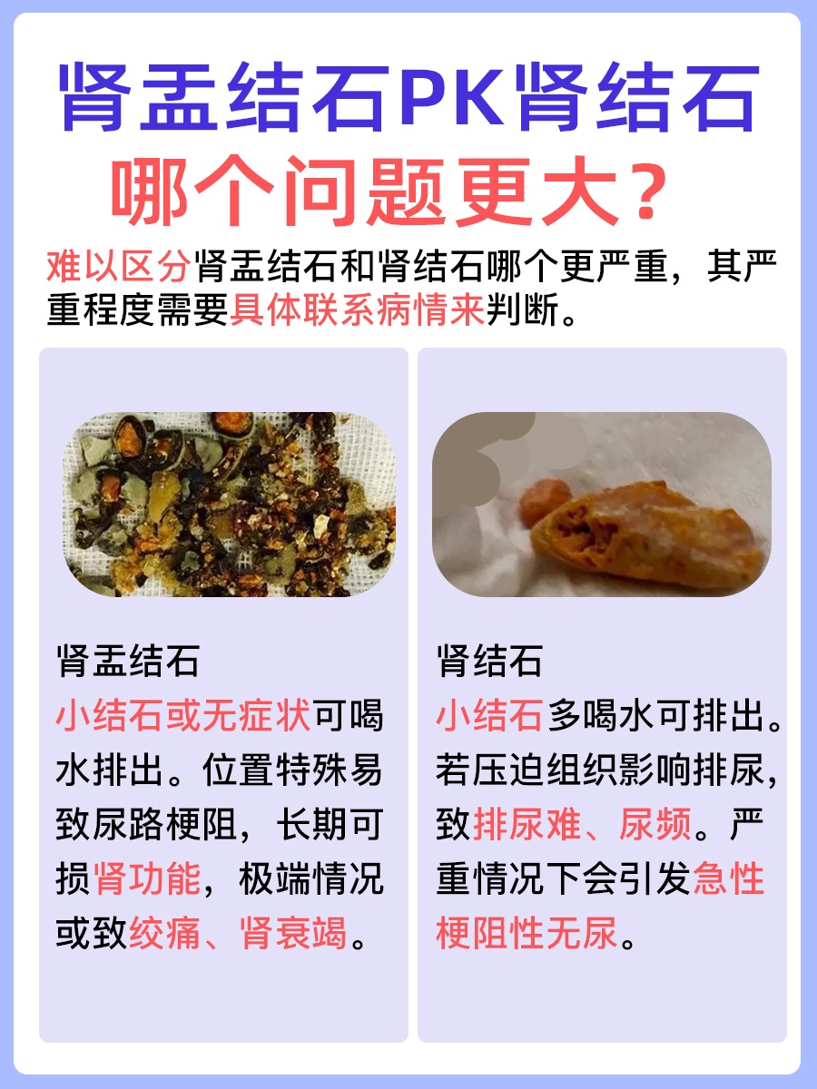 肾盂结石VS肾结石,哪个更棘手?