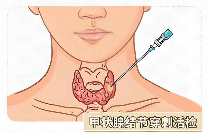 甲状腺穿刺活检3.jpg