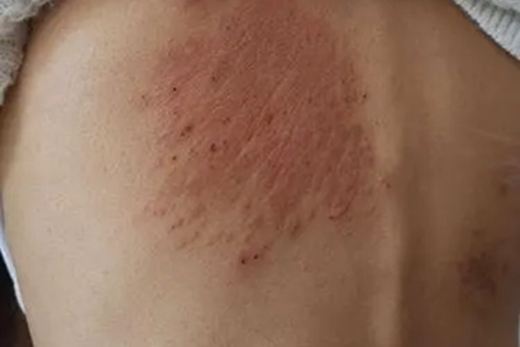 扁平苔藓样角化病背部皮肤粗糙图