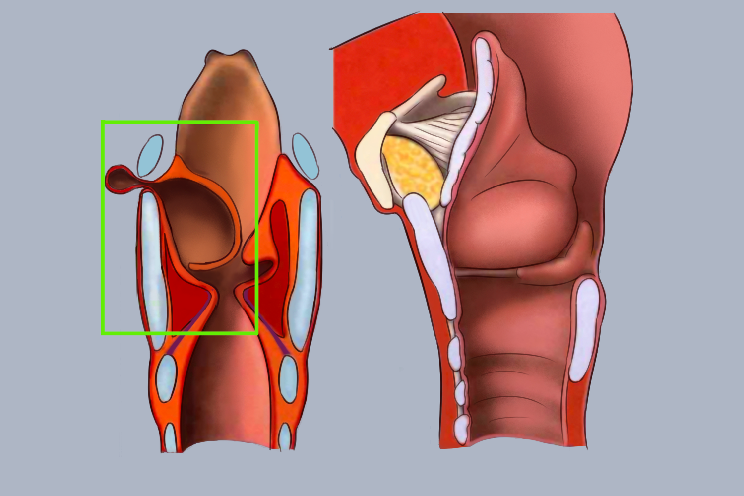 混合型喉外囊肿图