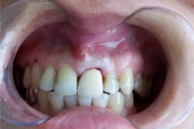 牙周脓肿小孔图