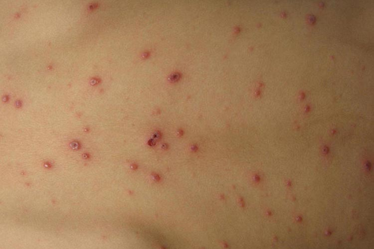 水痘结痂自己掉后图