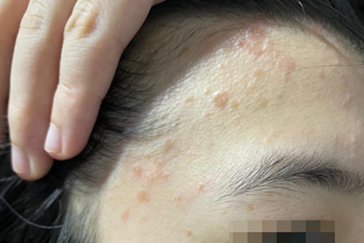 扁平疣额头浅褐色凸起斑块图 扁平疣额头浅褐色凸起斑块图
