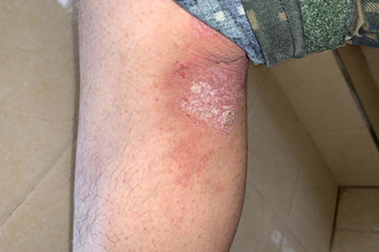 慢性接触性皮炎小腿红斑图