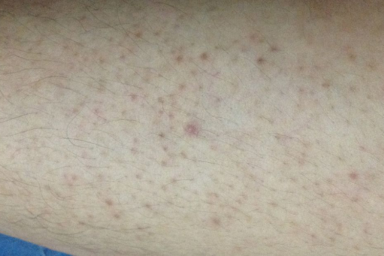 腿上HPV初期淡红色丘疹图 腿上HPV初期淡红色丘疹图