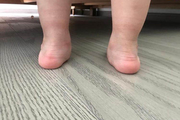 宝宝扁平足图 宝宝扁平足图