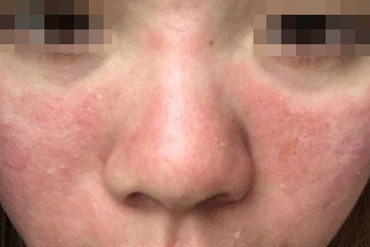 光毒性接触性皮炎面部发红图