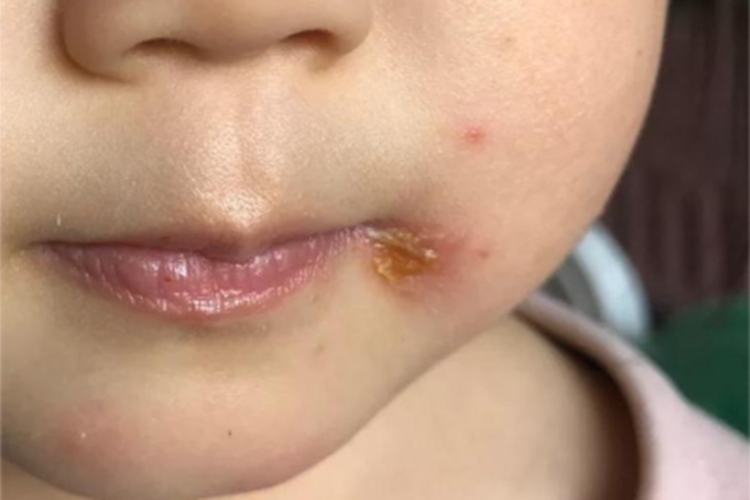 创伤性口角炎嘴唇黄痂图