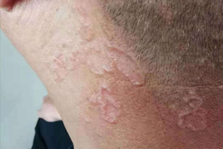 泛发型环状肉芽肿疙瘩图