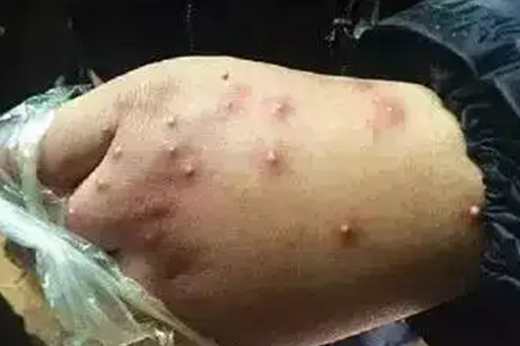 红火蚁咬人后症状图 红火蚁咬人后症状图