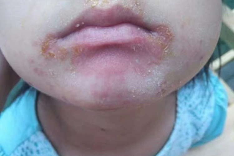 非大疱型脓疱疮口周黄痂脱屑图