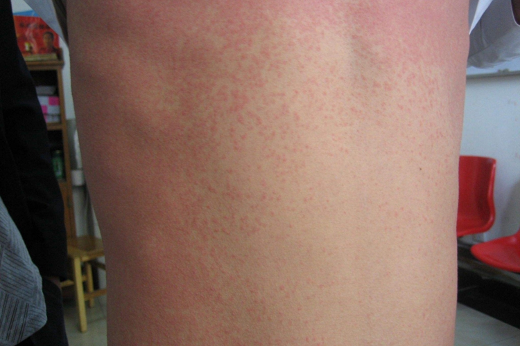 麻疹型药疹红色斑丘疹图