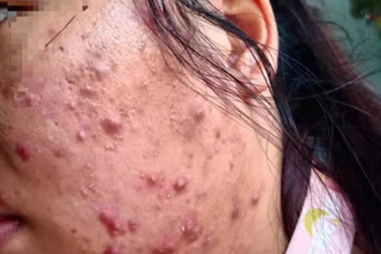 痤疮脸上有多个红色结节图