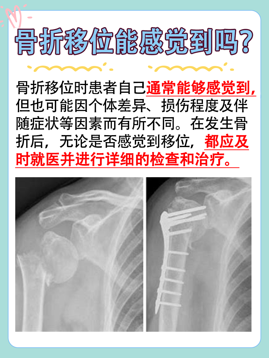 骨折移位感觉明显吗?揭晓自我感知可能性