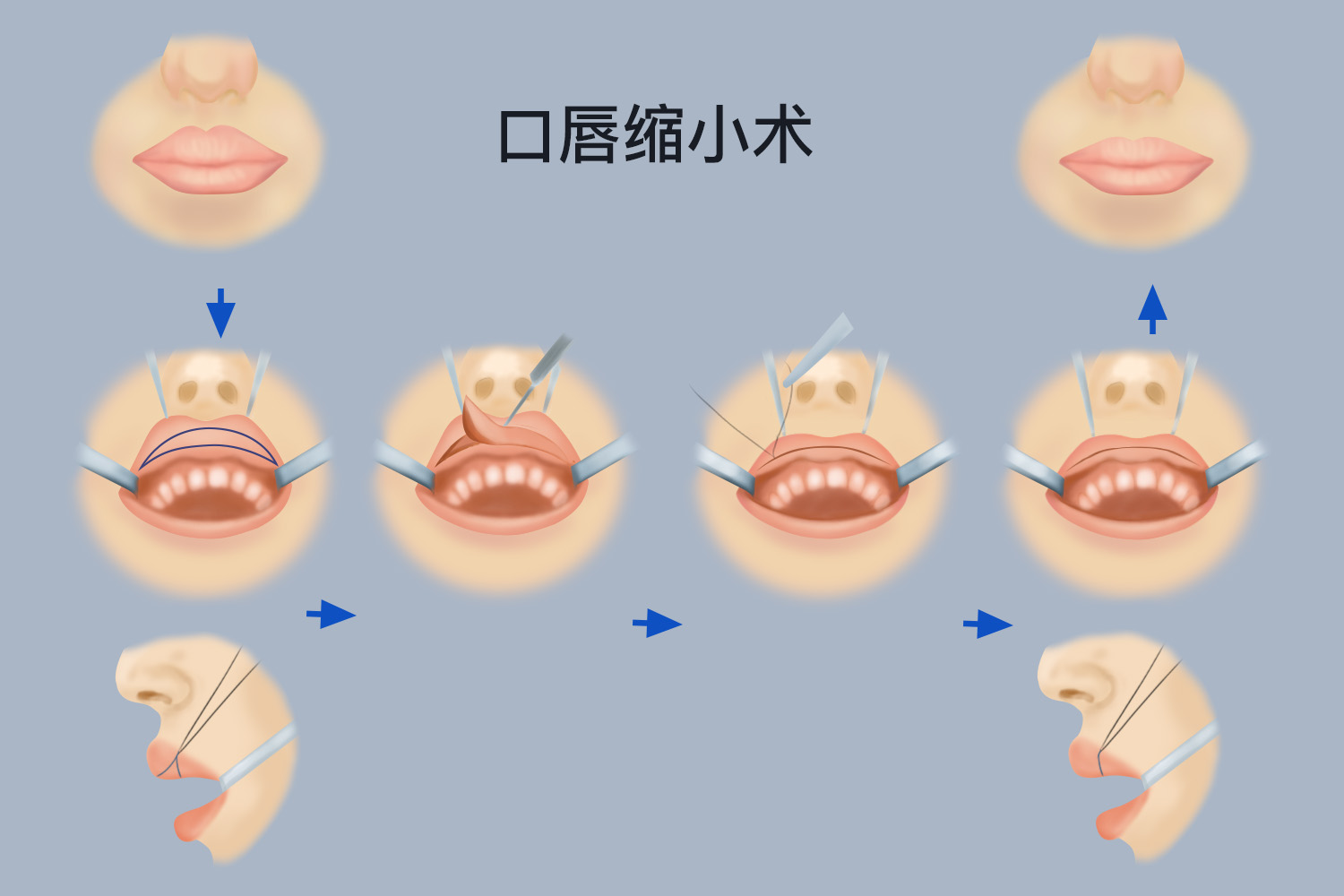 缩唇手术过程图