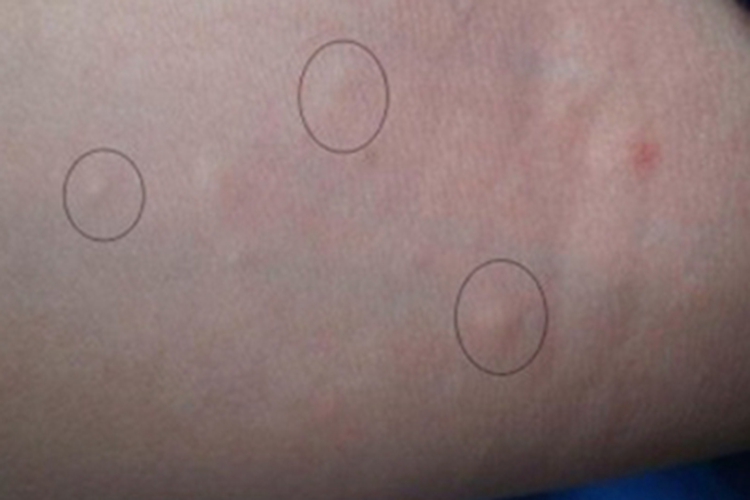 弓形虫病胳膊症状图