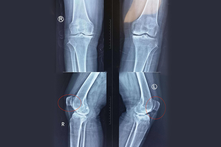 两侧髌骨骨质增生影像图