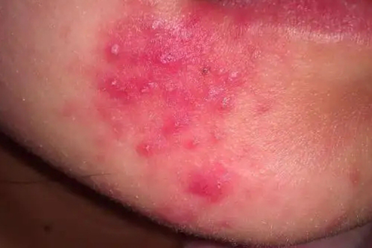 嘴角毛囊炎图 嘴角毛囊炎图