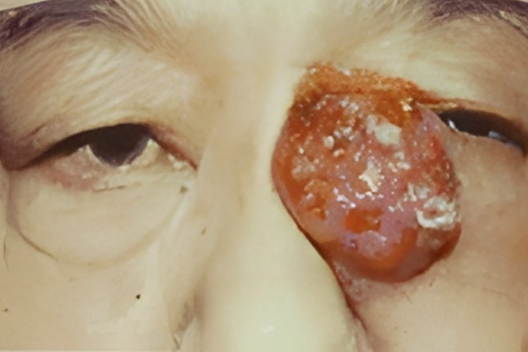 眼角处恶性泪囊肿瘤图