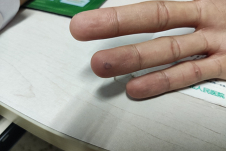 寻常疣手指上有环形斑图