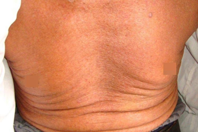 全身性瘙痒症胸部症状图 全身性瘙痒症胸部症状图