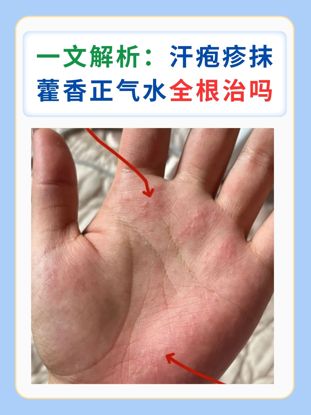一文解析:汗疱疹抹藿香正气水全根治吗