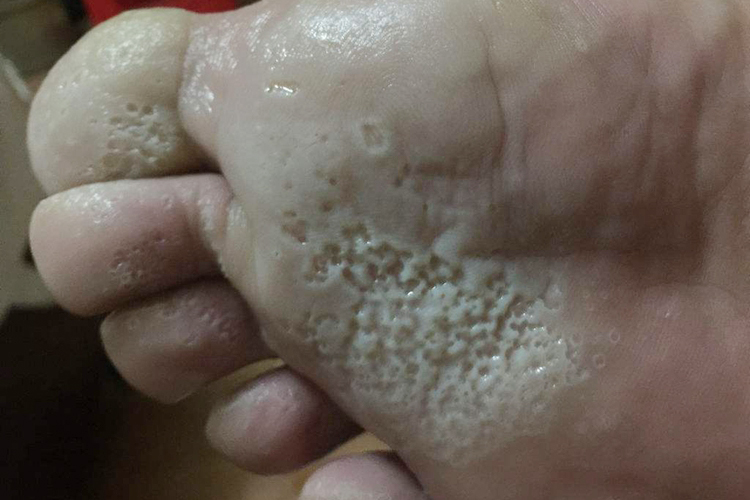 窝状角质松解症图 窝状角质松解症图