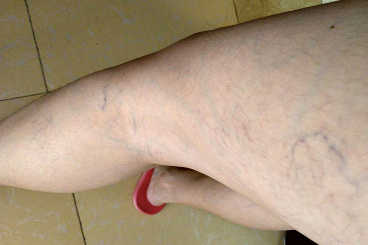 腿部毛细血管扩张图 腿部毛细血管扩张图