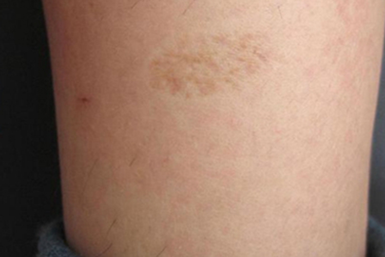 进行性特发性皮肤萎缩小腿斑图