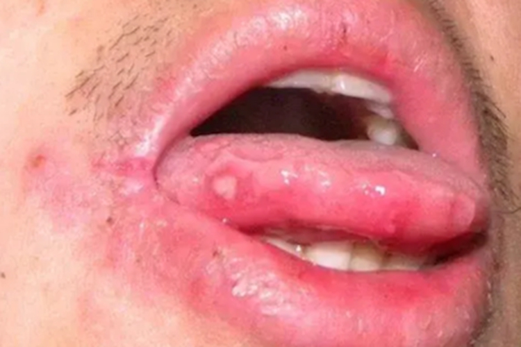 三期口腔梅毒舌侧白斑图片