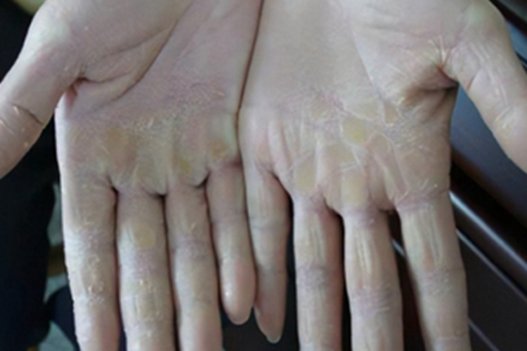 弥漫性掌跖角化病手掌皮肤增厚图