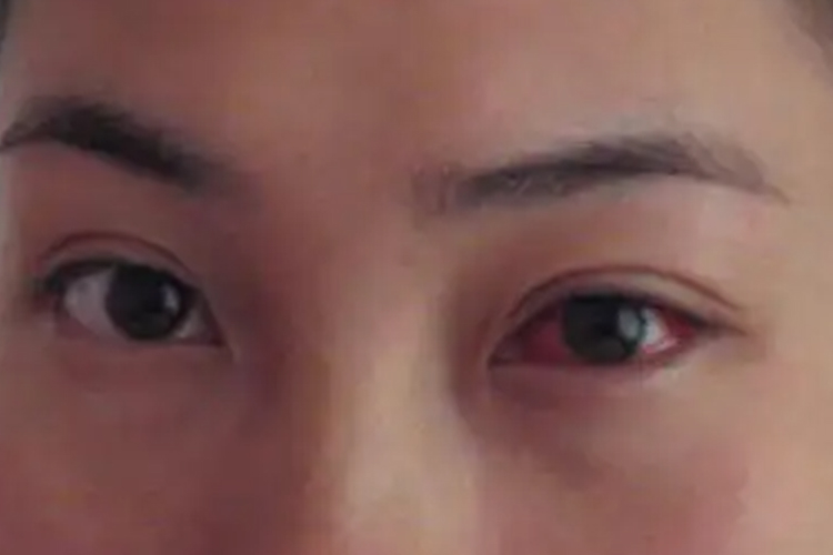 鼻腔鼻窦恶性肿瘤眼部流泪图