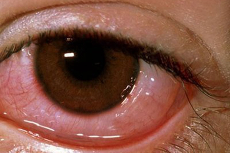 泪腺炎眼部症状图 泪腺炎眼部症状图