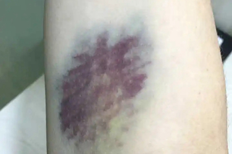 瘀斑小腿症状图