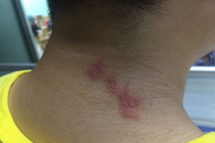 亚急性湿疹脖子上红一大片图