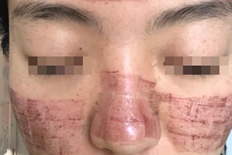 点阵激光祛色素沉着结痂图