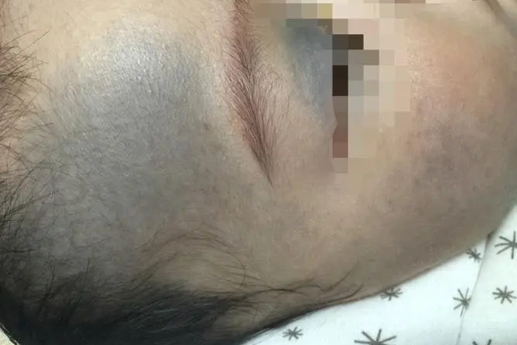 太田痣脸上发青图