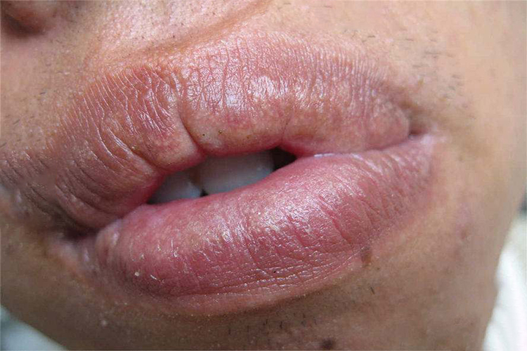 口唇上斑块状白色丘疹图