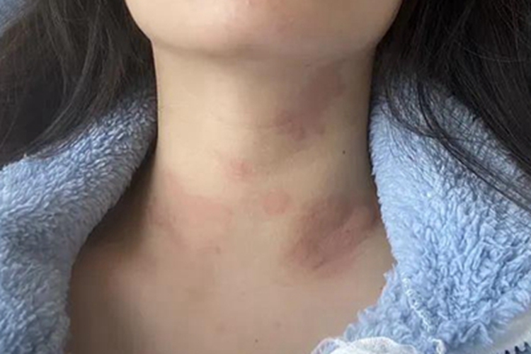 慢性自发性荨麻疹颈部症状图