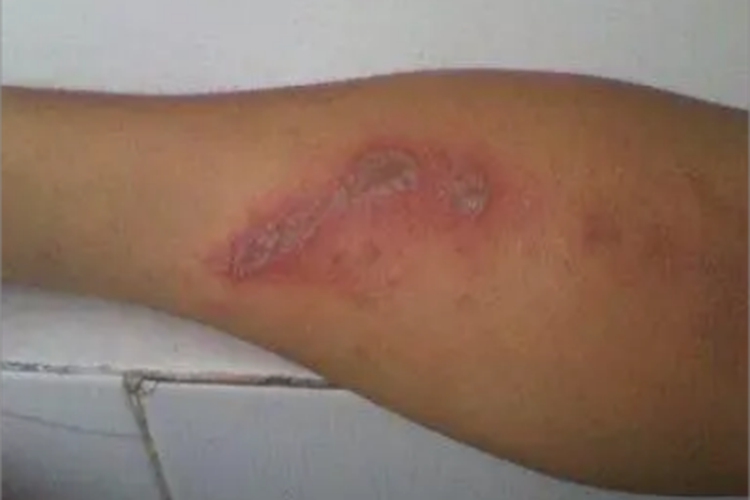 隐翅虫皮炎胳膊红斑图