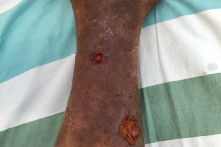 下肢静脉曲张小腿溃疡图