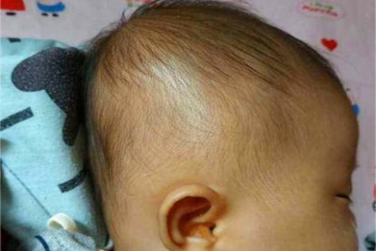狭颅症头后面变扁图 狭颅症头后面变扁图